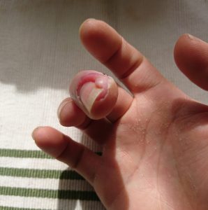 陥入爪 肉芽との闘い ツメがはがれた 基本net生活 陥入爪 肉芽との闘い ツメがはがれた 基本net生活